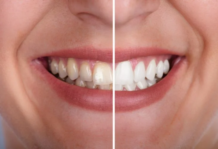 Clareamento Dental