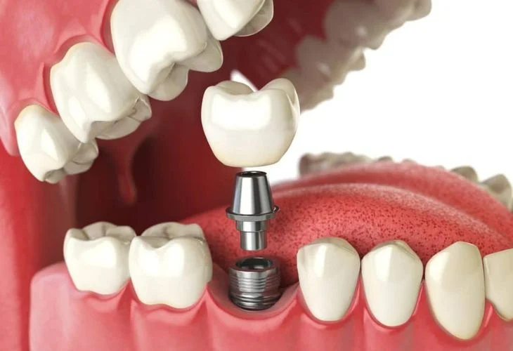 Implante Dentário