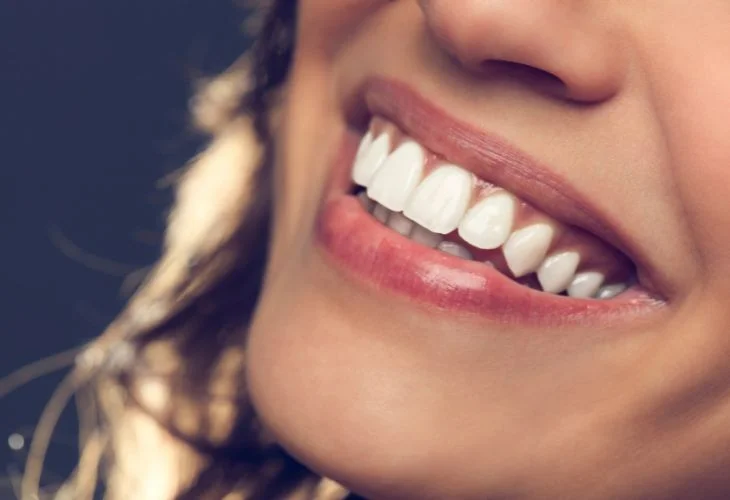 Lente de Contato Dental