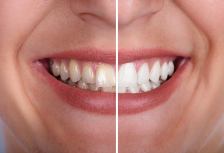 Clareamento Dental – Maceió AL